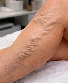 Condición inicial antes del tratamiento de varices