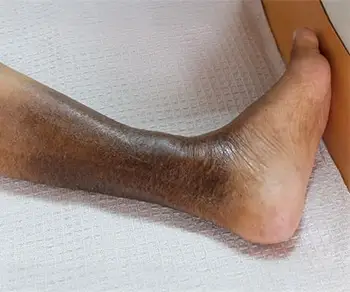 Cambios permanentes en la piel